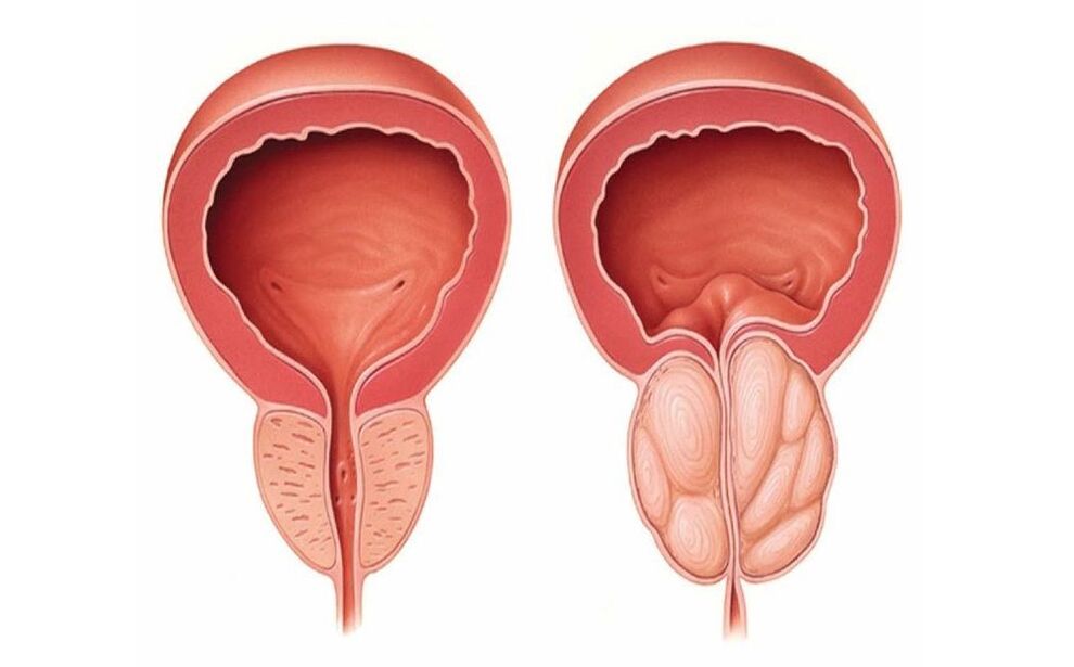 normal och inflammerad prostata