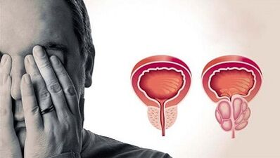 Orsakerna till utvecklingen av prostatit hos män