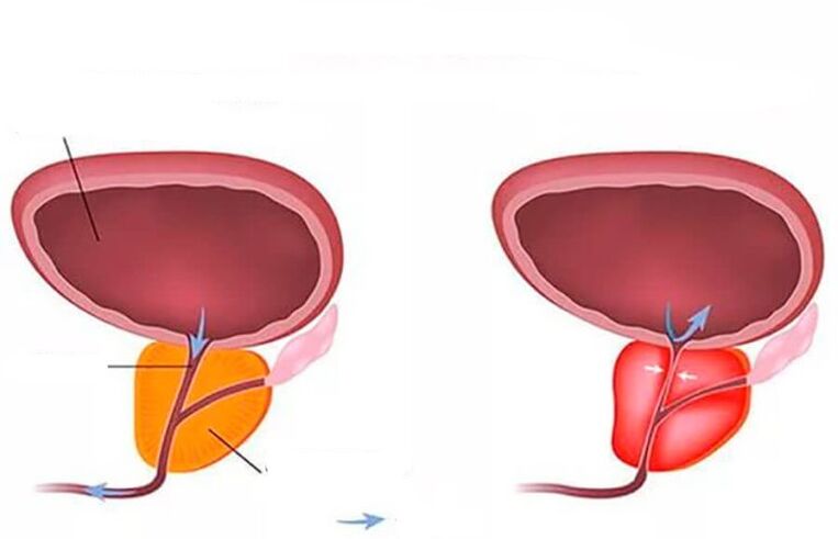 normal och inflammerad prostata