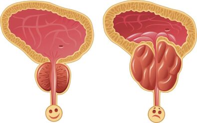 Frisk och inflammerad manlig prostata