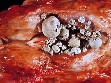 Stenar i prostatakörteln med calculous prostatit