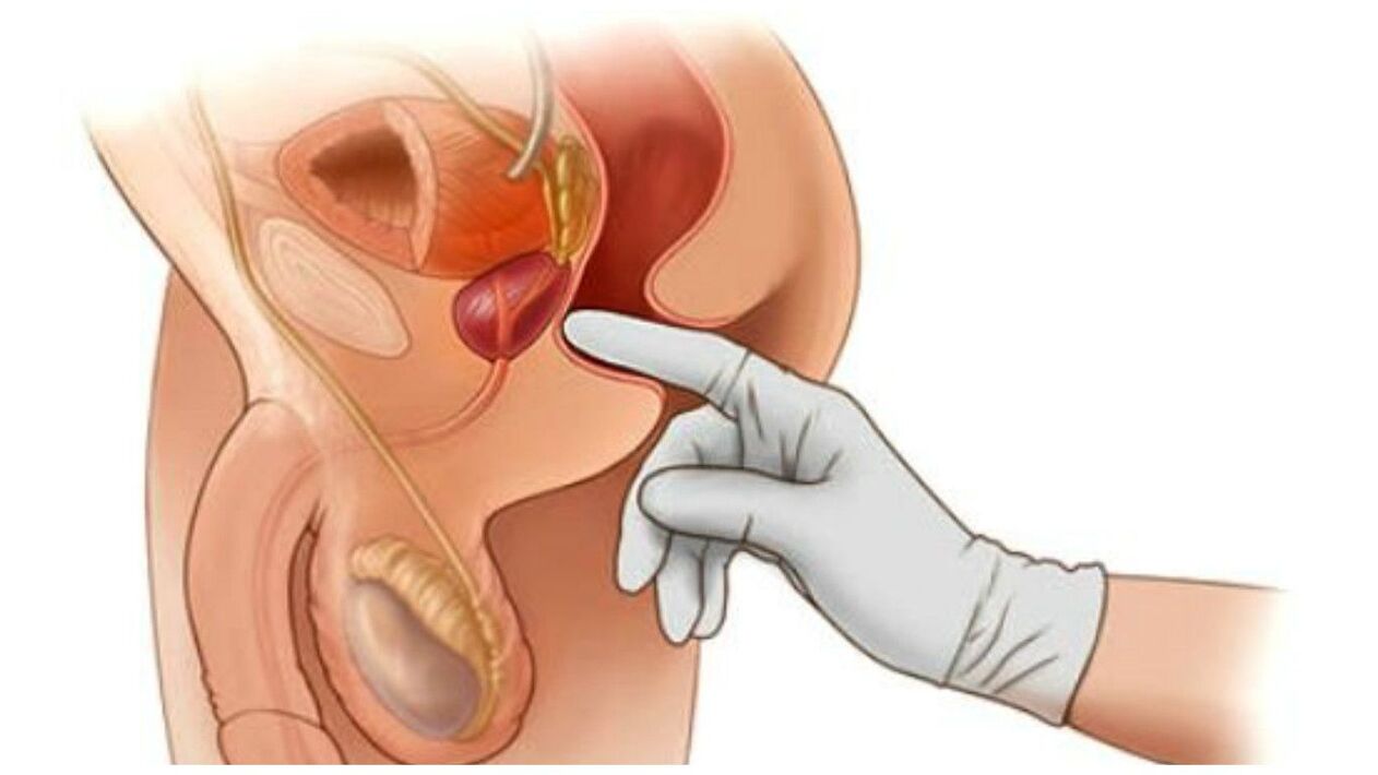 prostata massage