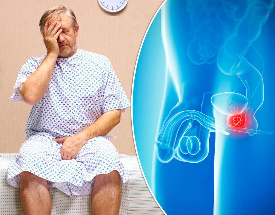 En man med prostatit diagnostiseras med en sjukdom