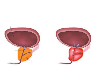 Normal och inflammerad prostata